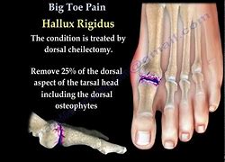 Image result for Sharp Pain in Big Toe Joint
