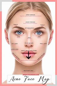 Image result for Men Acne Face Map