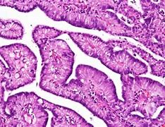 Image result for Molluscum Contagiosum Histology Image