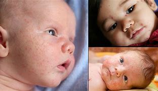 Image result for Kids with Pimples