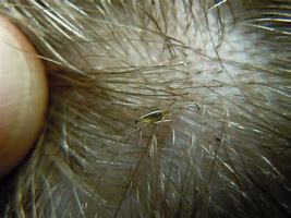 Image result for Bed Lice
