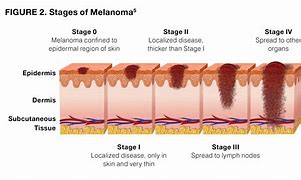 Image result for Metastatic Melanoma Skin Cancer