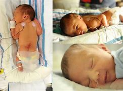 Image result for Child with Spina Bifida