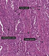 Image result for Small Cell Carcinoma Diagram