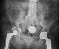 Image result for Partially Calcified Uterine Fibroid