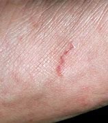 Image result for Scabies Bites