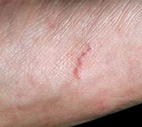 Image result for Scabies Linear
