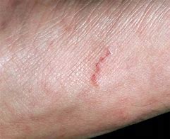 Image result for Scabies On Wrist