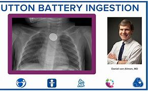 Image result for Button Battery Ingestion
