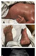 Image result for Exfoliative Dermatitis Erythroderma