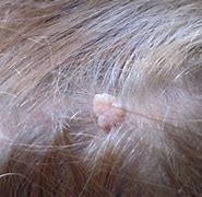 Image result for Scalp Papilloma