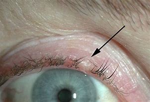 Image result for Common Eyelid Growths