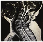 Image result for Cervical Spine C5 C6 Narrowing
