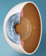 Image result for Artificial Eye Lens