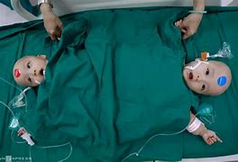 Image result for Triplet Conjoined Twins