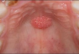 Image result for Squamous Papilloma Nose