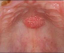Image result for Squamous Cell Papilloma
