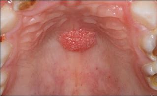 Image result for Squamous Papilomas