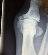 Image result for Bone Spur On Big Toe