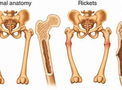 Image result for Rickets vs Normal