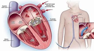 Image result for Heart Valve Replacement Recovery