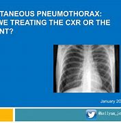 Image result for Spontaneous Pneumothorax Management