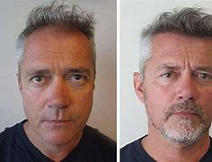 Image result for Amazing Hair Transplant