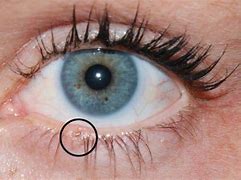 Image result for Growth On Lower Eyelid