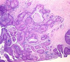 Image result for Genital Skin Cancer
