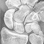 Image result for Accessory Sesamoid Bone Hand