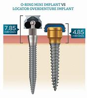 Image result for Locator Implant Attachment System