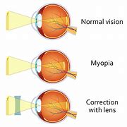 Myopia 的图像结果