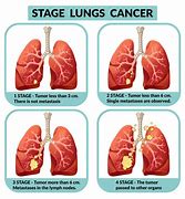 Image result for Advanced Lung Cancer