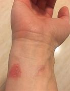 Image result for Wrist Watch Skin Marks
