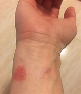 Image result for Apple Watch Strap Allergy