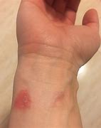 Image result for Wrist Watch Skin Marks