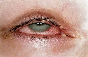 Image result for Molluscum Contagiosum Treatment Eye Lids