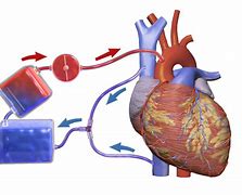 Image result for Heart and Lung Bypass