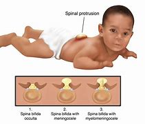 Image result for Spina Bifida Baby Cartoon