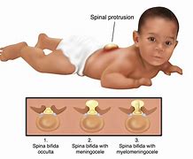 Image result for Spina Bifida Children
