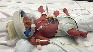 Image result for Preemie Premature Baby