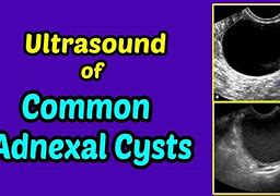 Image result for Right Adnexal Cyst 9Mm