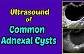 Image result for Management of Adnexal Cyst