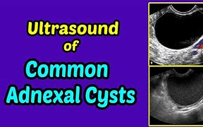 Image result for Adnexal Cyst with Polyp Ultrasound