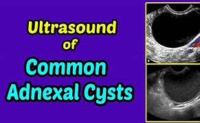 Image result for Adnexal Cyst Is It Cancer