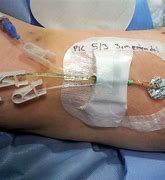 Image result for Types of PICC Line Catheters