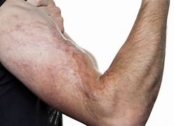Image result for Burn Scars On Arm