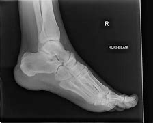 Image result for Normal Foot X-ray