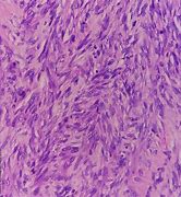Image result for 5 Cm Fibroid in Uterine