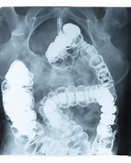 Image result for 5 mm Polyp in Sigmoid Colon